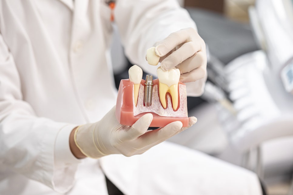 까치산치과, 전체임플란트로 잃어버린 치아를 되찾으세요. 관련 이미지 6