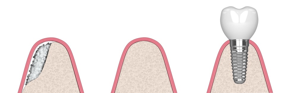 화곡임플란트치과, 임플란트 뼈이식 꼭 다 해야 할까요? 관련 이미지 3