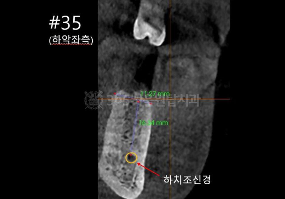 화곡동임플란트, 수술 전 CT에서 꼭 확인해야하는 3가지 관련 이미지 5