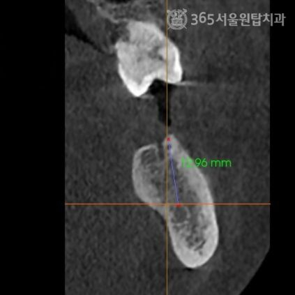 마곡임플란트 재수술, 이번이 마지막이 되려면? 관련 이미지 3