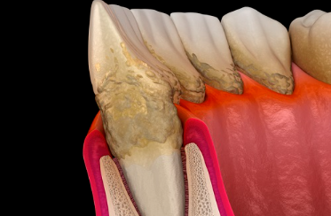 신월동치과 임플란트 심는 자리만 보면 안 되는 이유 관련 이미지 6