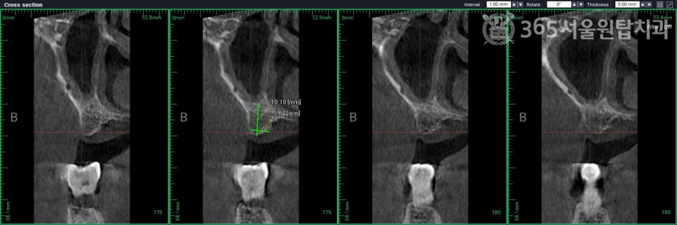 Sinwol-dong Dentist: 3D Digital Implants That Reduce Treatment Errors image 4
