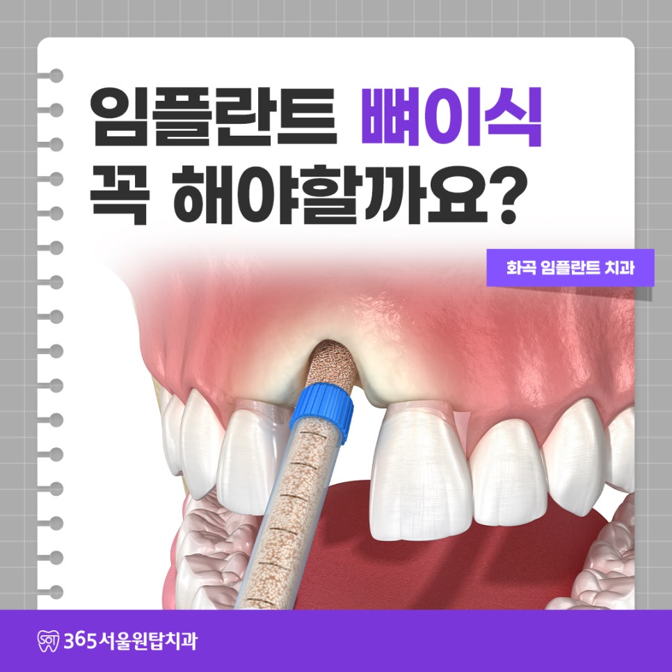 화곡임플란트치과, 임플란트 뼈이식 꼭 다 해야 할까요? 관련 이미지 9