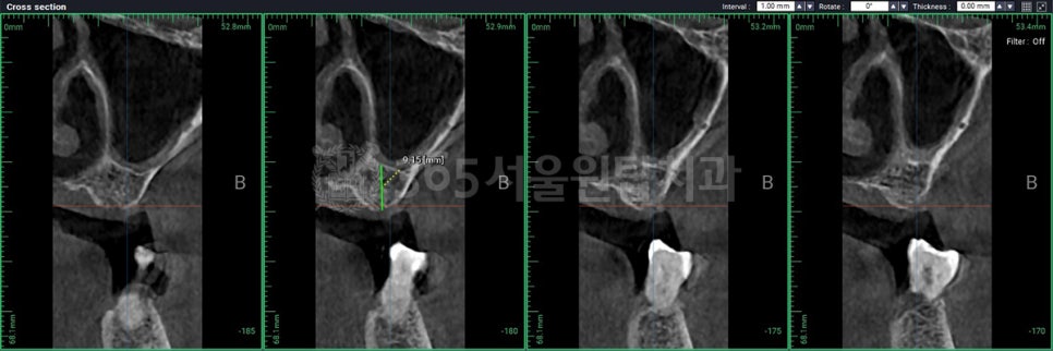 강서구 임플란트, 진료실에서 전하고 싶었던 이야기 관련 이미지 7