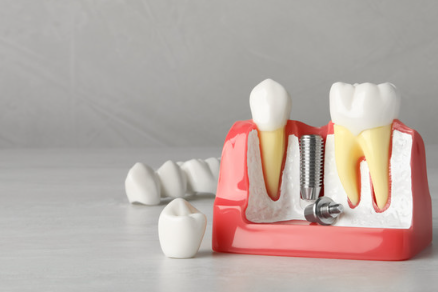 우장산치과 당뇨가 있어도 임플란트 가능할까요? 관련 이미지 5