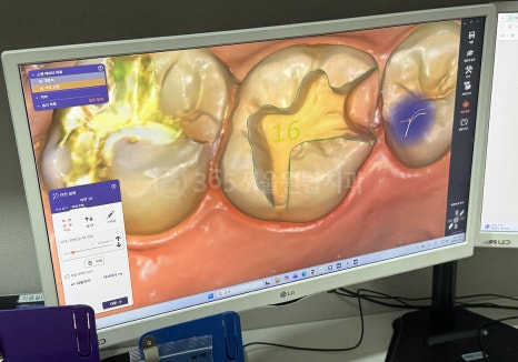 강서구 보철치과, Primemill (프라임밀) 장비를 선택한 이유 관련 이미지 5
