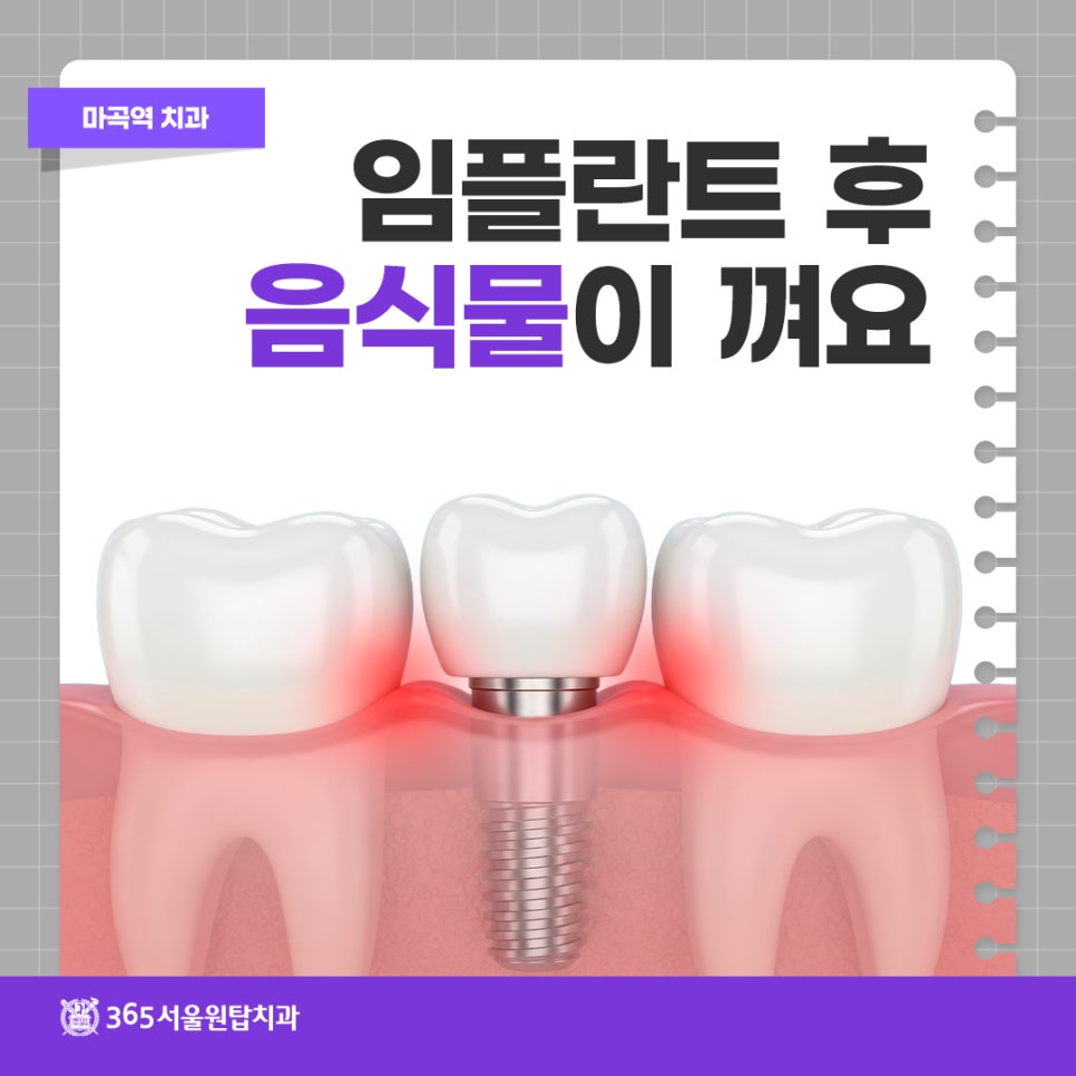 마곡역치과, 임플란트 후 음식물이 껴요 관련 이미지 10