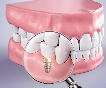 신월동치과 임플란트 심는 자리만 보면 안 되는 이유 관련 이미지 11