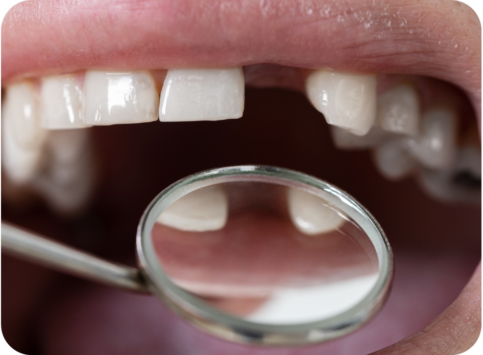 신월동임플란트, 치아 상실이 뇌 건강에 미치는 영향 관련 이미지 6