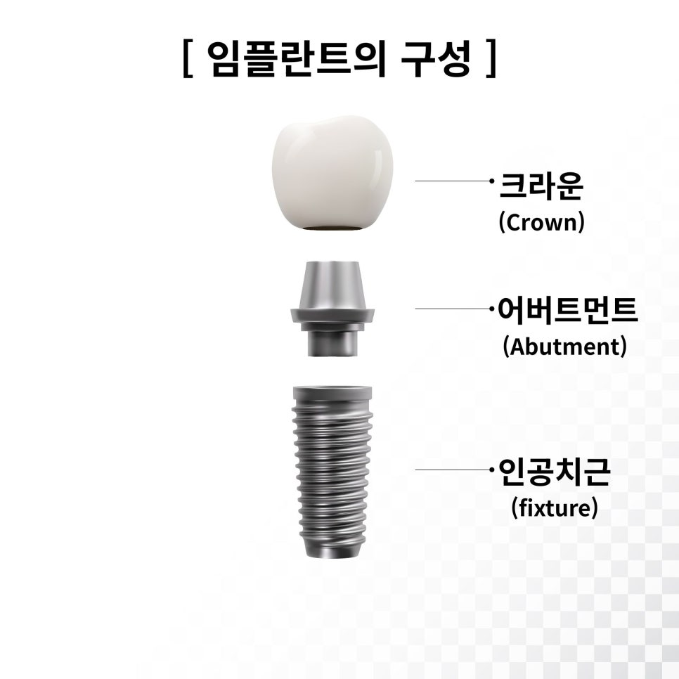 우장산역치과, 임플란트 한 곳이 흔들릴 때? 관련 이미지 4