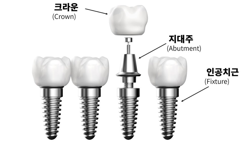같은 임플란트인데 왜 가격이 다를까, 365서울원탑치과 관련 이미지 6