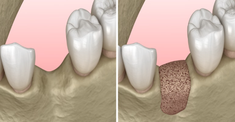 화곡역치과 치아가 빠진 개수만큼 임플란트를 심어야 될까? 관련 이미지 5