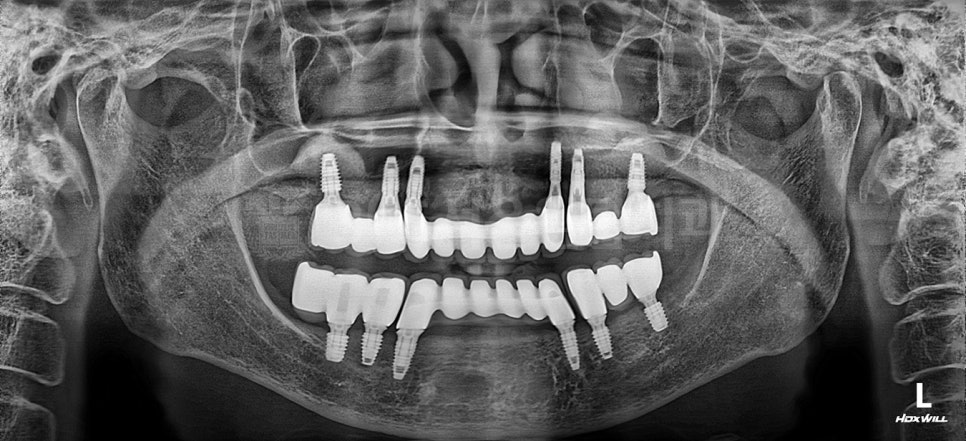 강서구 임플란트, 진료실에서 전하고 싶었던 이야기 관련 이미지 6