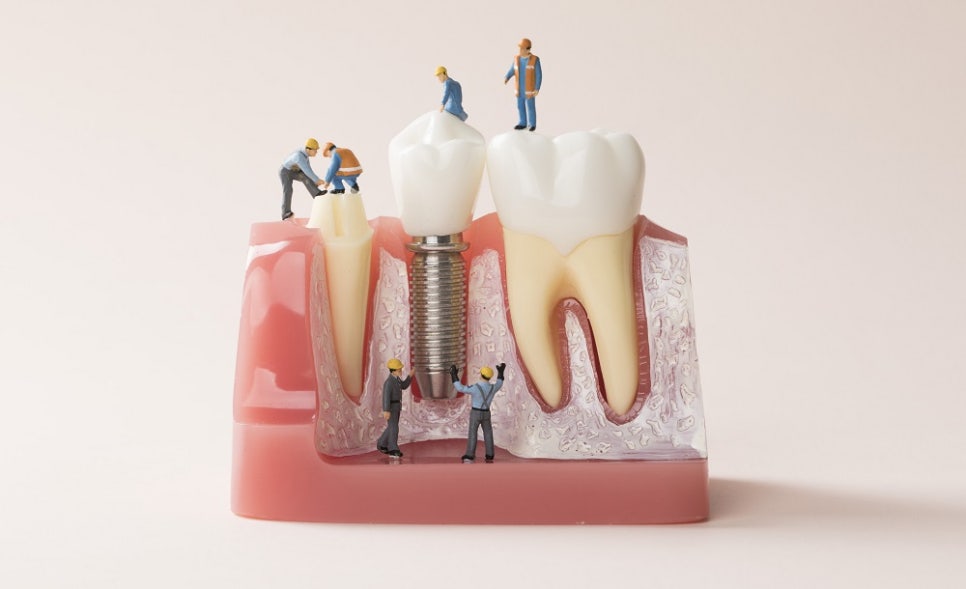 염창동치과 임플란트 주위염과 치주인대, 자연치아와 다른 이유 관련 이미지 4