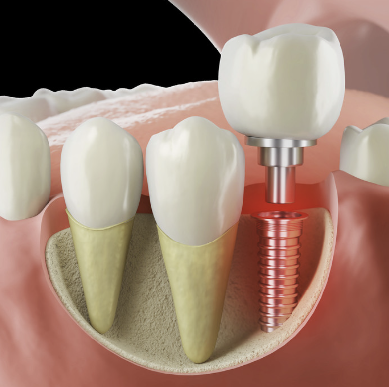 강서구청치과 임플란트 오래 쓰려면 피해야할 이것 관련 이미지 7