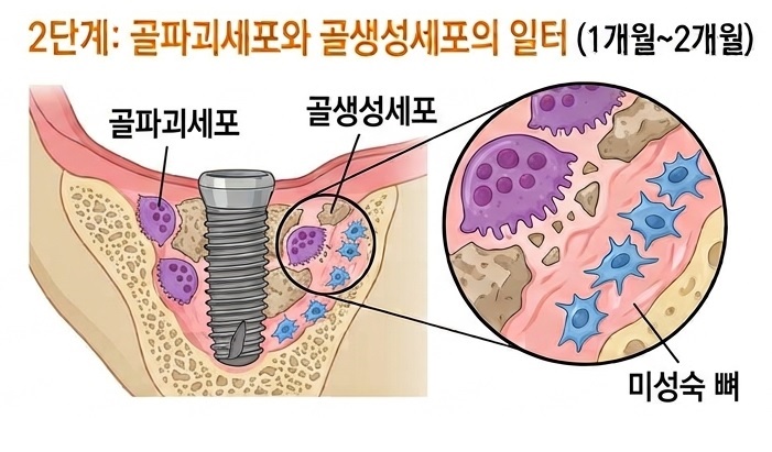 강서구 임플란트치과 , 임플란트 뼈이식이 자리를 잡기까지 관련 이미지 4