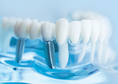 신월동치과 임플란트 심는 자리만 보면 안 되는 이유 관련 이미지 2