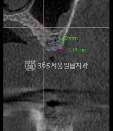 화곡동치과 2030 임플란트, 가격보다 중요한 체크리스트! 관련 이미지 4