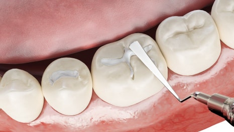 Yangcheon-gu Dental Clinic: 3 Problems That Can Occur If You Miss the Time to Replace Dental Prostheses image 2