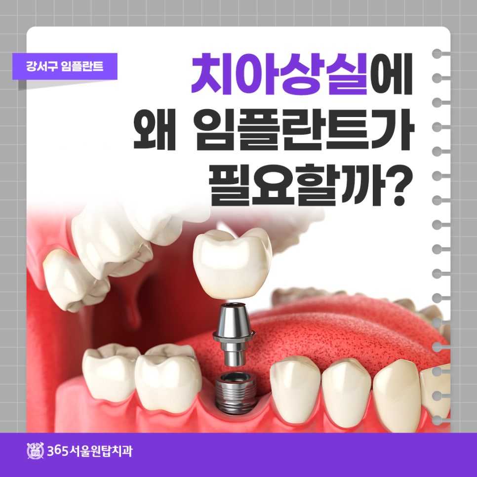 강서구임플란트, 치아 상실에 왜 임플란트가 필요할까 관련 이미지 6