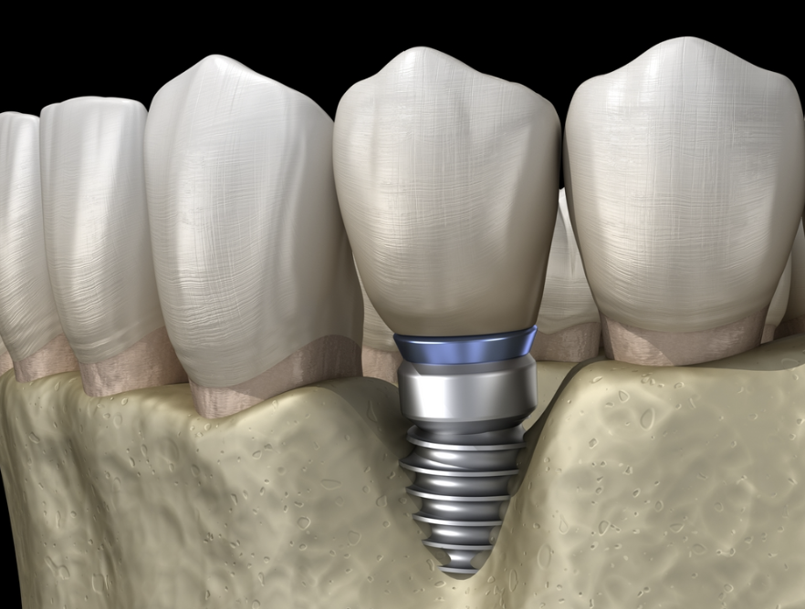 강서구청치과 임플란트 오래 쓰려면 피해야할 이것 관련 이미지 3