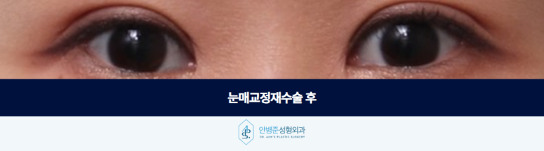 눈매교정재수술 라인이 풀리고 졸려 보인다면 확인해야 할 것은 관련 이미지 3