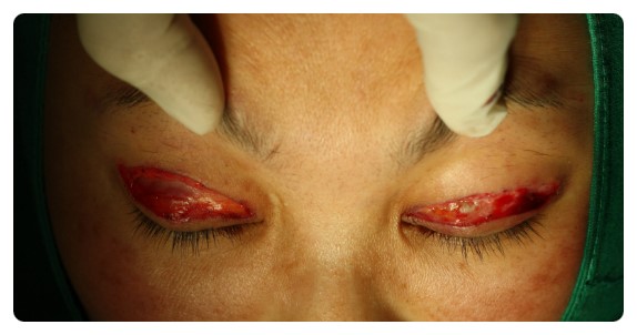 -소시지눈 고치기 과정-        [안병준의 눈이야기] 관련 이미지 7