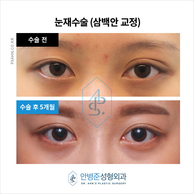 [눈재수술] 눈매 수술과 속눈썹 내반증 교정: 더 자연스럽고 편안한 눈을 위한 해결책 관련 이미지 1