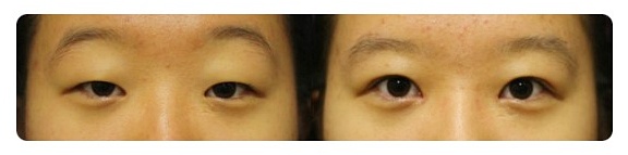 안검하수 눈매교정 가짜와 진짜를 구분해야 합니다 관련 이미지 2