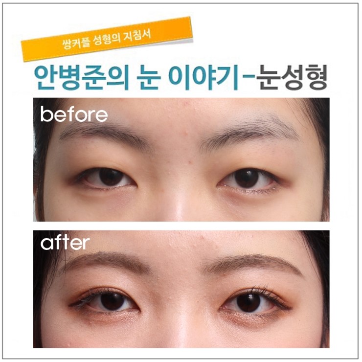 수술중에 필요할 수 있는 눈매교정.(피부절제,눈매교정) 관련 이미지 1