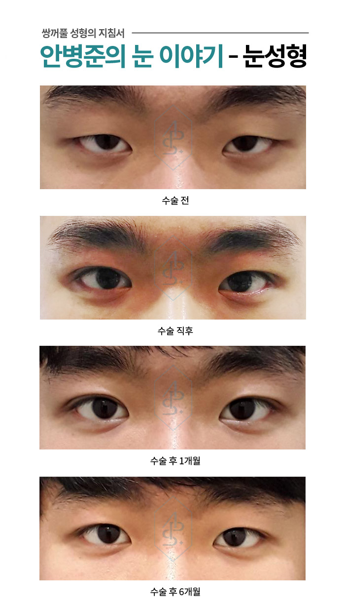 [남자눈] 완전 무쌍 눈매교정 및 속쌍꺼풀 눈매교정 관련 이미지 1