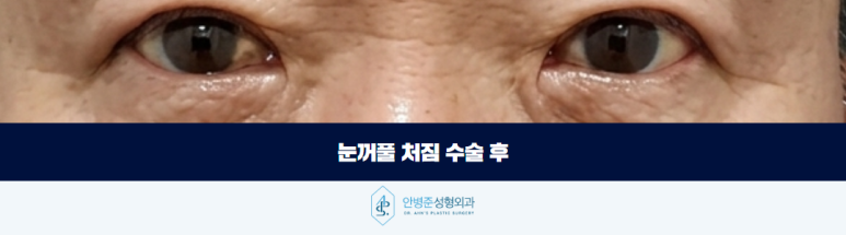 눈꺼풀 처짐 이마 거상이 정답일까요 관련 이미지 4