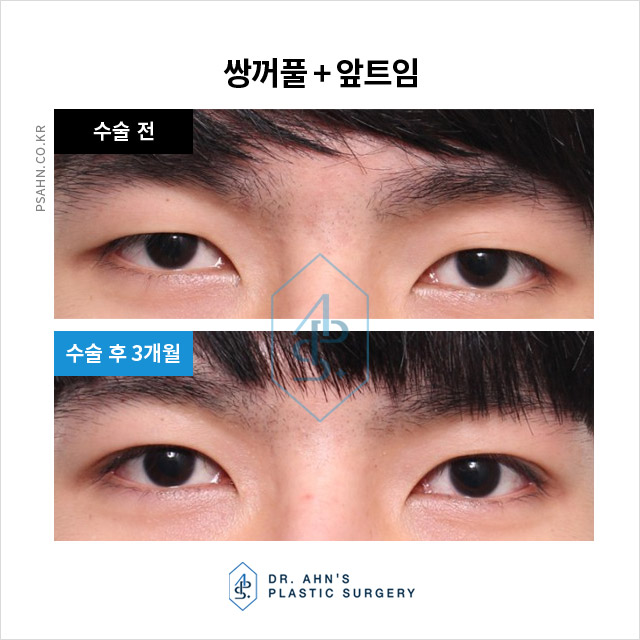 [남자눈성형] 개인의 외적 자신감 및 사회적 이미지 향상?! 관련 이미지 5