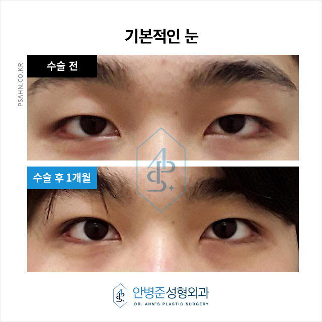 [남자눈성형] 남자 쌍꺼풀, 여자와 다른 자연스러움의 포인트? 관련 이미지 2
