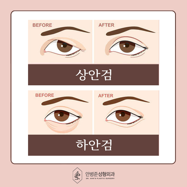 [눈성형]50대도 동안 유지! 상안검&하안검 성형으로 자신감 찾기 관련 이미지 2