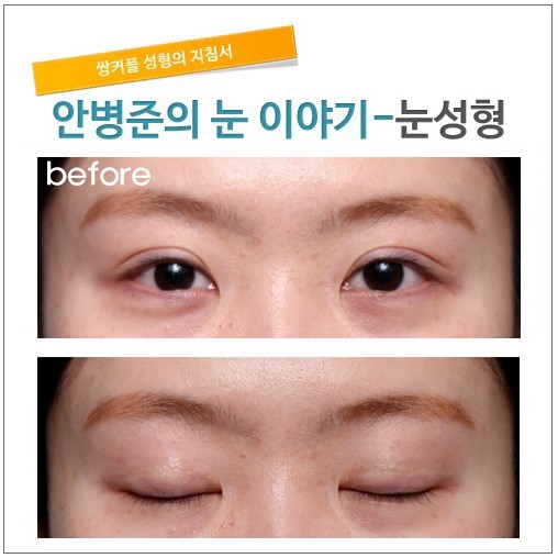 소시지눈을 자연쌍꺼풀처럼 고치기.(소시지눈,소시지눈재수술,쌍꺼풀재수술) 관련 이미지 1