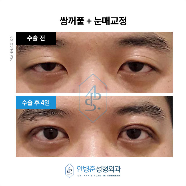 [눈성형]피부 처짐으로 가려진 안검하수, 정확한 진단! 중요합니다 관련 이미지 2