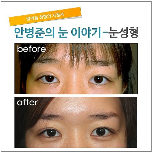 심한 짝짝이눈 고치기 관련 이미지 1