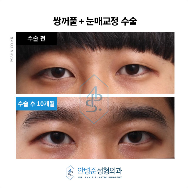 [쌍꺼풀수술] 남성 눈성형, 절개? 매몰? 중요한 건 관련 이미지 1