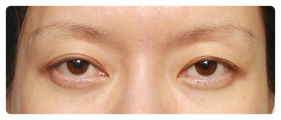 삼백안이란? 원인과 교정 관련 이미지 3