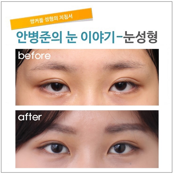 삼백안의 정확한 설명(삼백안,피부절제,안검하수) 관련 이미지 3