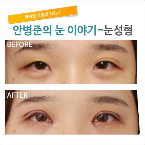 쌍커풀수술 4개월째 경과 관련 이미지 1