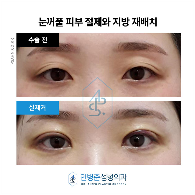 눈꺼풀 처짐,중앙부위에 지방이 없고 겹주름 수술사례 관련 이미지 4