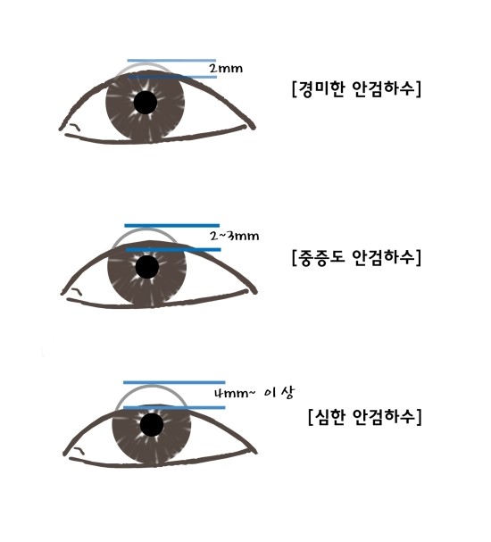 진짜 안검하수와 가짜 안검하수.(안검하수) 관련 이미지 1