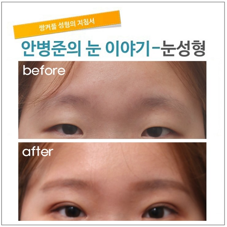 눈매교정으로 인한 이마의 변화. 관련 이미지 1