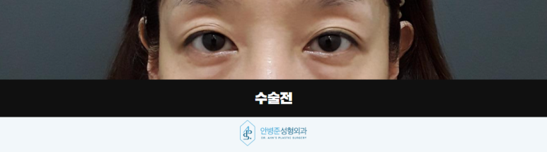 상하안검수술 필요한 순간 위아래 눈꺼풀을 함께 보는 이유 관련 이미지 2