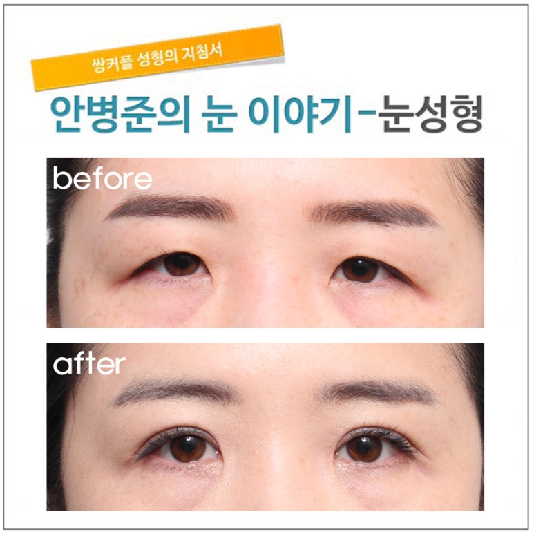 노화로 인한 피부처짐이 많은 눈(눈피부처짐,늘어진눈피부,눈절제) 관련 이미지 1