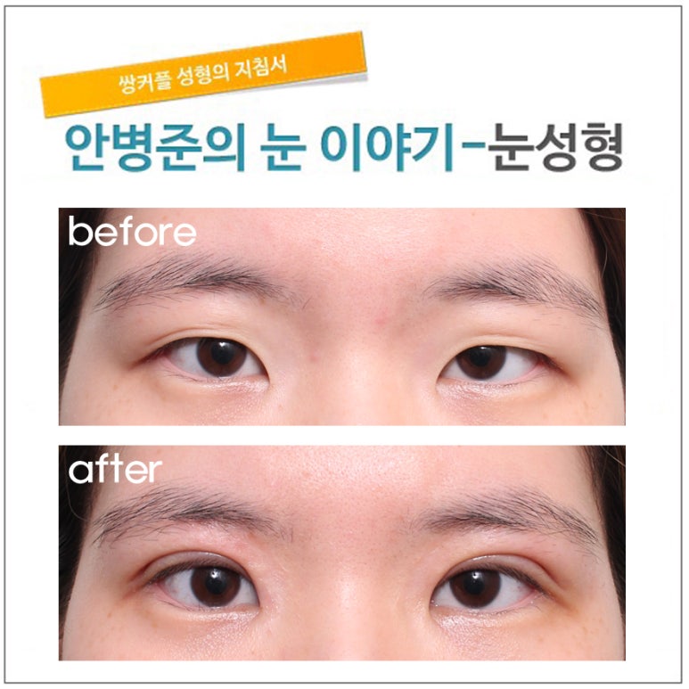 처진 피부와 몽고주름 관련 이미지 1