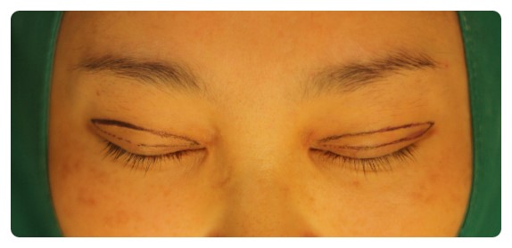 -소시지눈 고치기 과정-        [안병준의 눈이야기] 관련 이미지 3