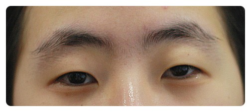 (안검하수)쌍꺼풀,눈매교정,앞트임        [안병준의 눈이야기] 관련 이미지 1